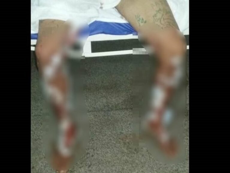 Por dívida de drogas, traficantes jogam gasolina e ateiam fogo em “cliente” de 29 anos em Rondônia