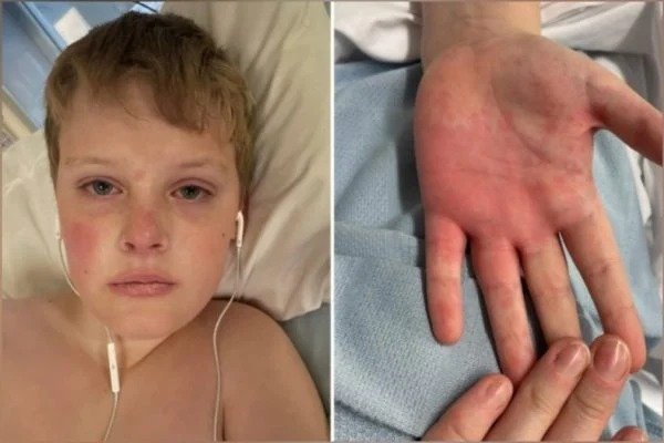 Menino de 11 anos quase morre com doença rara associada à Covid
