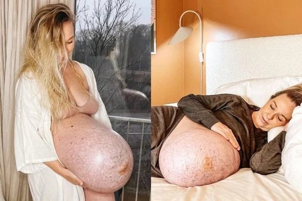Formato da barriga de influencer grávida chama atenção na web; entenda 2 Formato da barriga de influencer grávida chama atenção na web; entenda