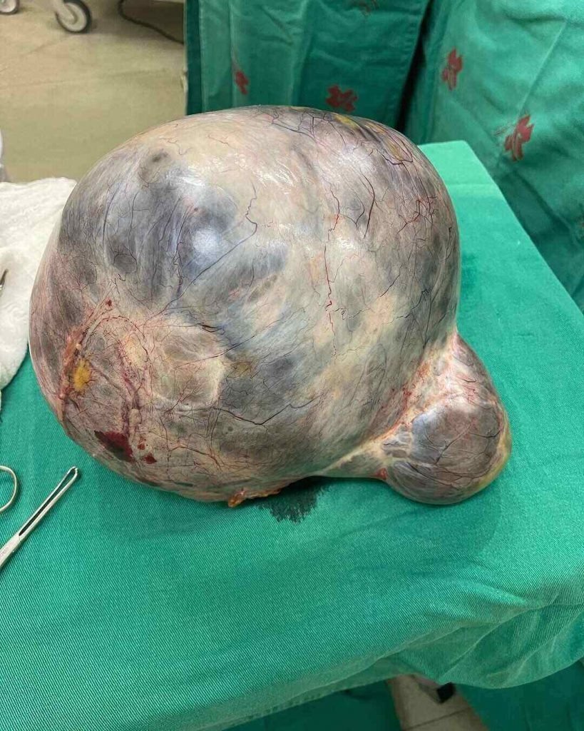 Idosa retira cisto gigante de 10 kg no norte do Rio; veja fotos