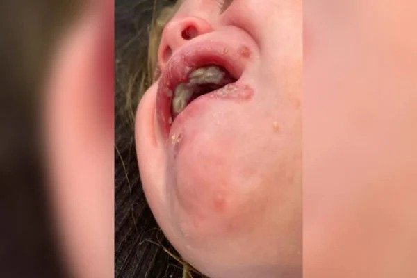 “Não deixe ninguém beijar seu filho”, alerta mãe de bebê com herpes