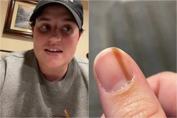 Mulher descobre câncer após investigar mancha escura em unha