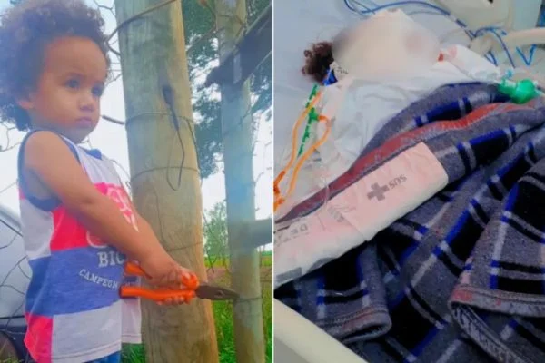 Criança tem 80% do corpo queimado por água quente de panela em Goiás