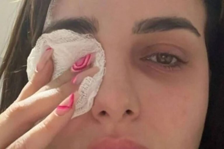 Youtuber arranca pedaço da córnea ao coçar olho: “Pior noite”