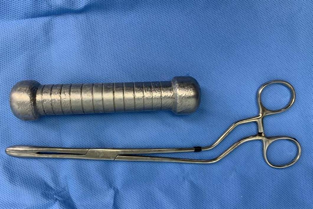 Médicos encontram peso de academia de 2 quilos dentro de paciente 2 Médicos encontram peso de academia de 2 quilos dentro de paciente