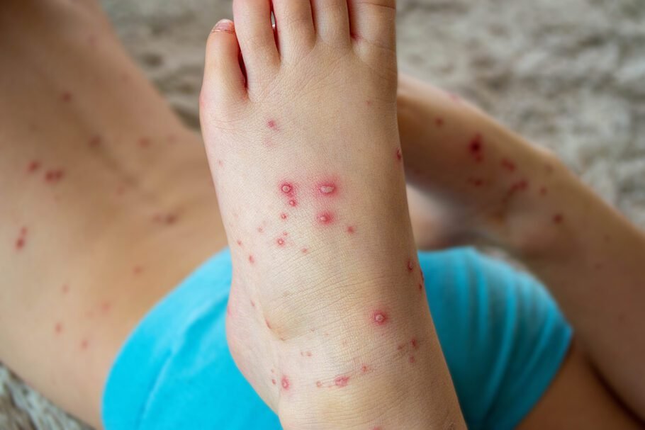 Vírus apelidado de ‘gripe do tomate’ infecta 82 crianças