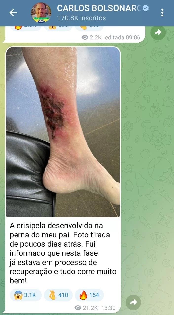 Carlos Bolsonaro publica foto da perna do pai com erisipela