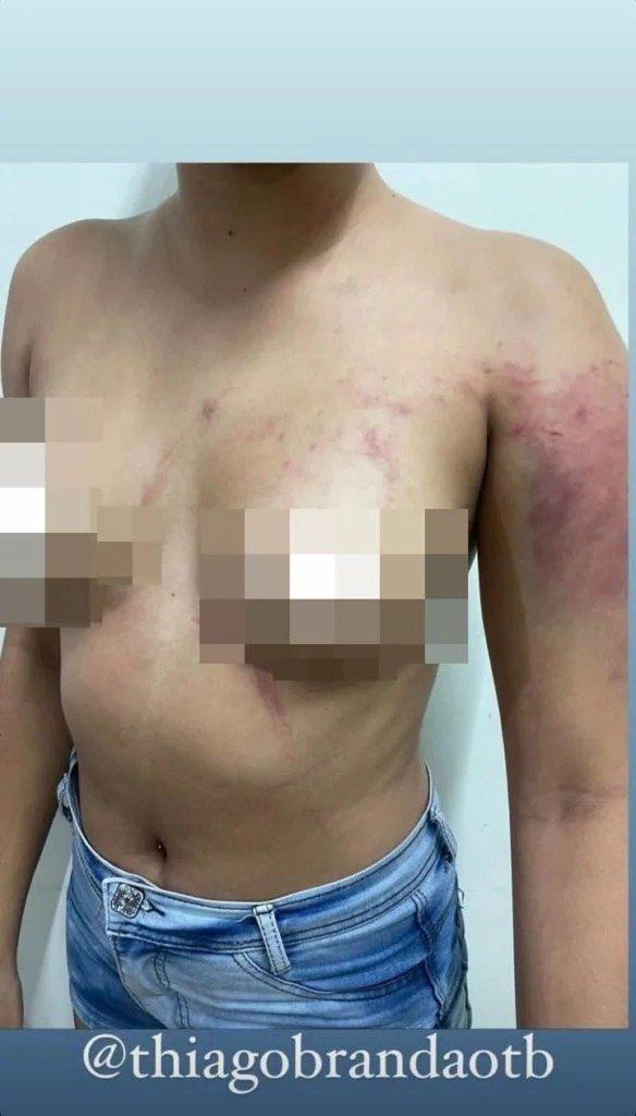 Mulher é espancada pelo namorado por beber cerveja “sem permissão”