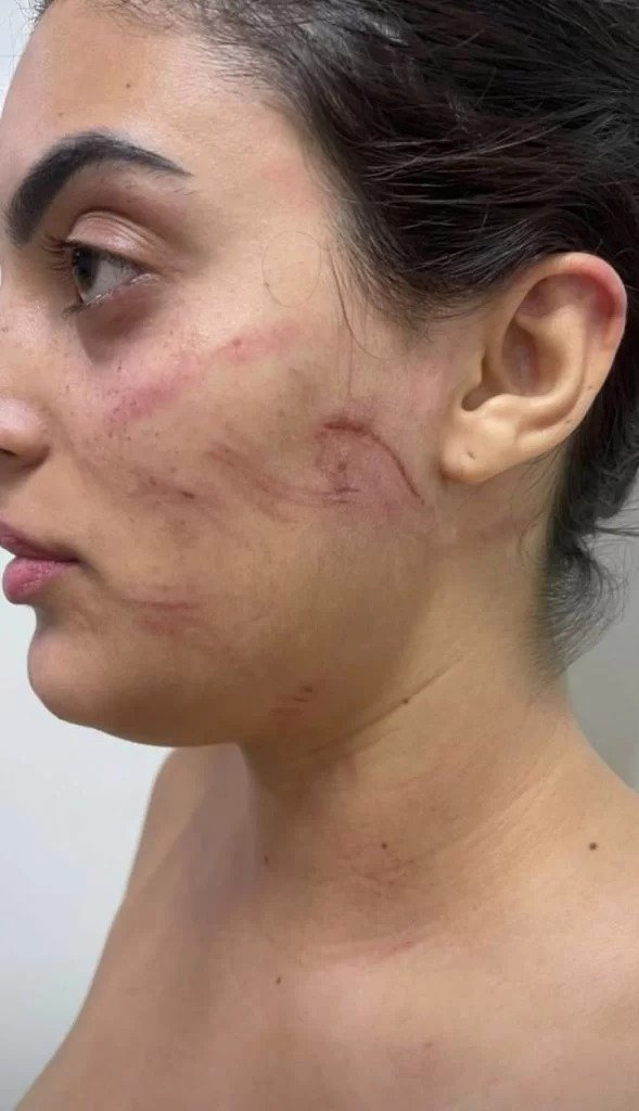 Mulher é espancada pelo namorado por beber cerveja “sem permissão”