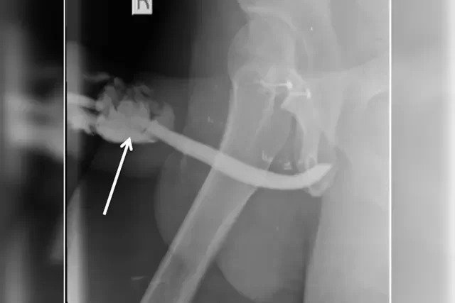 Homem quebra o pênis em 3 lugares durante posição sexual perigosa