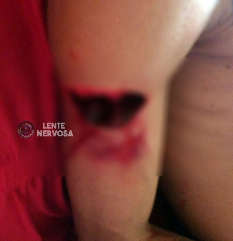 Últimas Notícias 1 Jovem quase tem o braço decepado em ataque com facão na zona leste – VEJA FOTOS