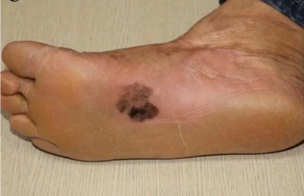 Melanoma acral: câncer de pele grave é mais comum no Norte do país 1 Melanoma acral: câncer de pele grave é mais comum no Norte do país