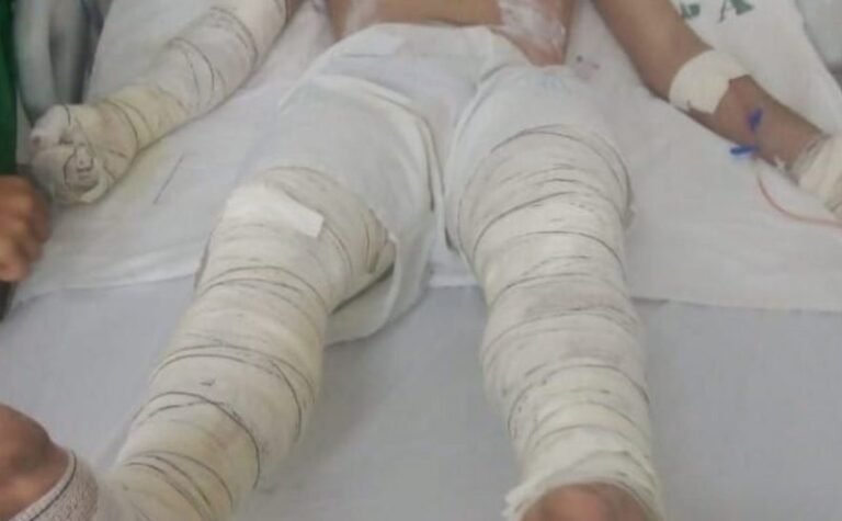 Jovem sofre graves queimaduras em explosão ao tentar acender churrasqueira, em RO