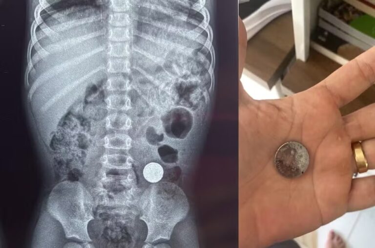 Criança de 3 anos engole bateria de lítio e é internada com dor abdominal em RO