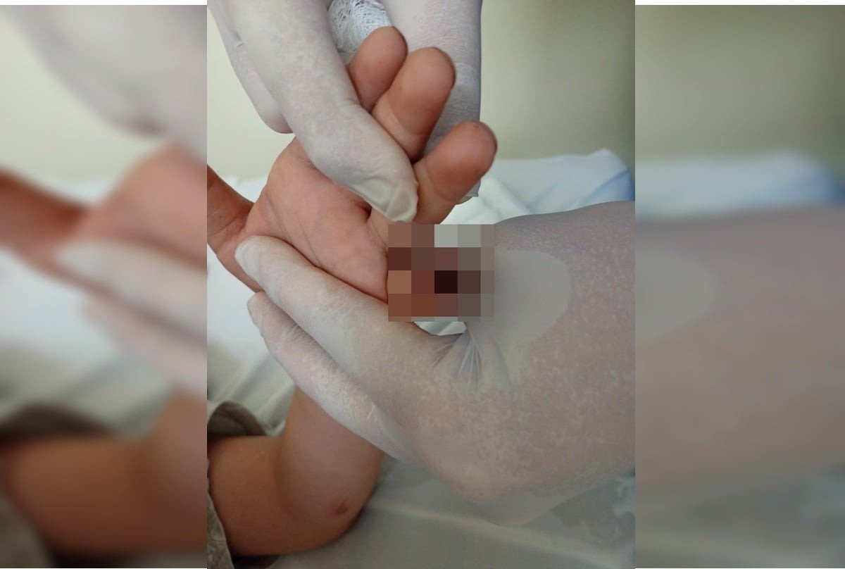 “Risco de necrosar”, diz mãe de menino autista que teve dedo decepado