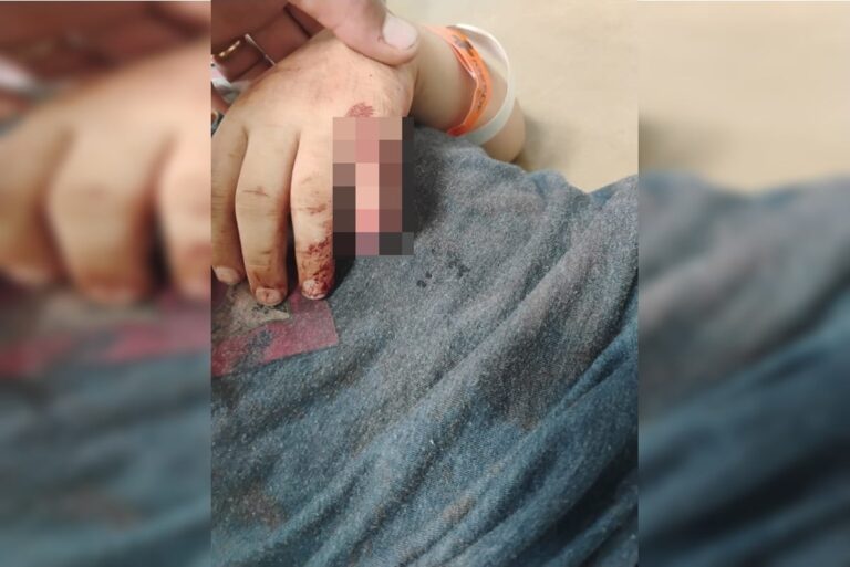 “Risco de necrosar”, diz mãe de menino autista que teve dedo decepado