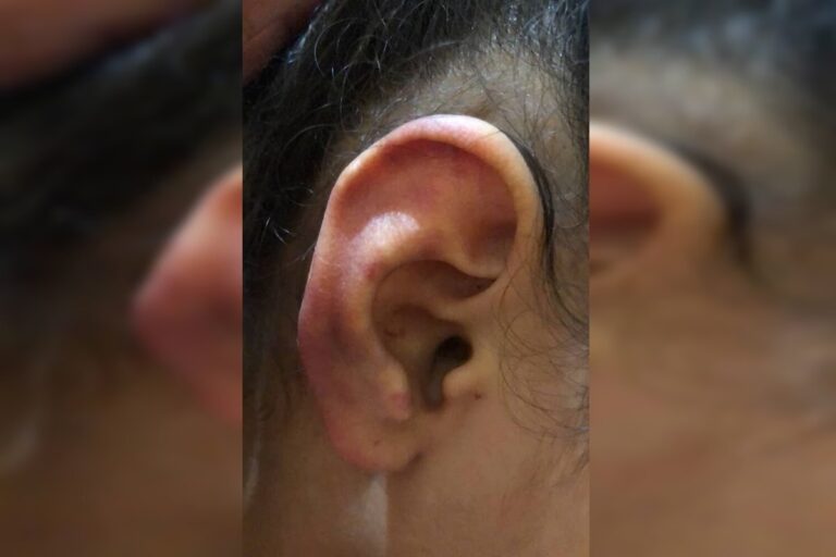 Chinelada e soco no olho: menina é espancada por pai ao tomar Toddynho