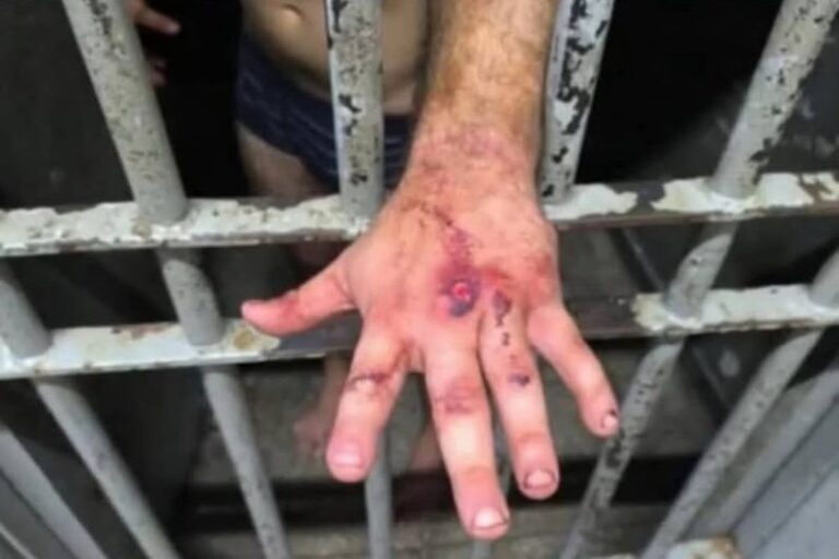 Veja como ficou a mão de ex-jogador após agredir mulher com 61 socos – VÍDEO