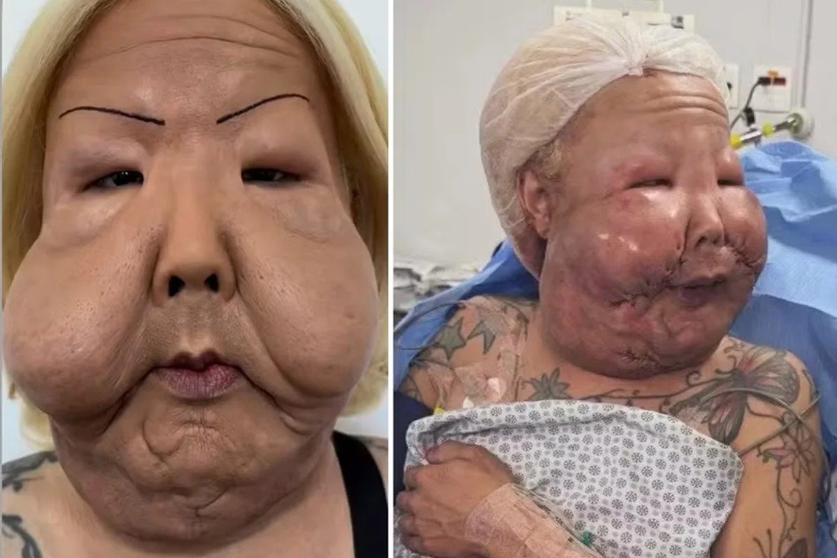 Juju do Pix mostra como ficou o rosto um mês após retirar óleo mineral