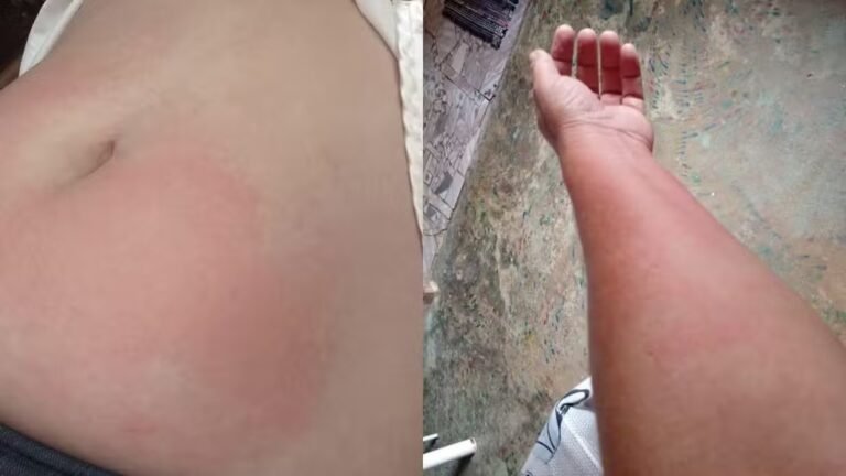 Últimas Notícias 2 Alergia à água: rondoniense luta contra doença rara que transforma até o suor em risco