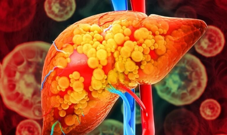 Hepatologistas contam os piores alimentos que causam gordura no fígado