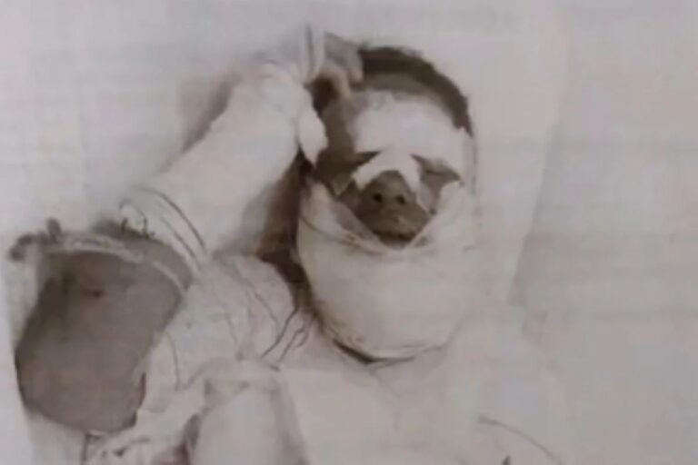 Últimas Notícias 8 Após briga, homem joga álcool e ateia fogo no rosto de companheira