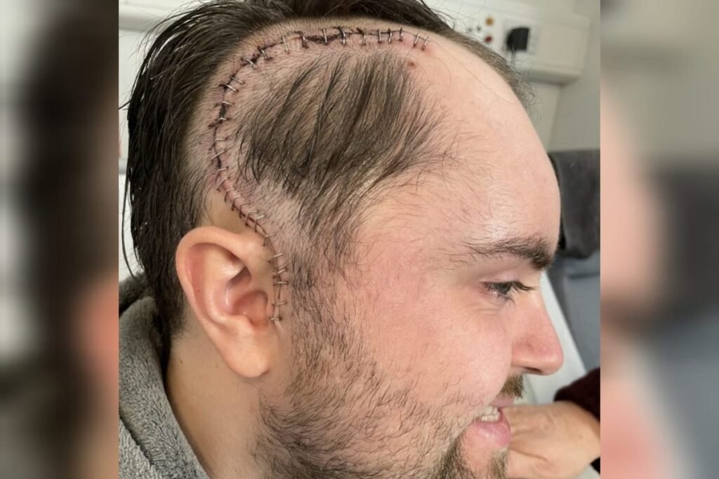 Homem ignora sinais de tumor no cérebro achando ser dor de musculação