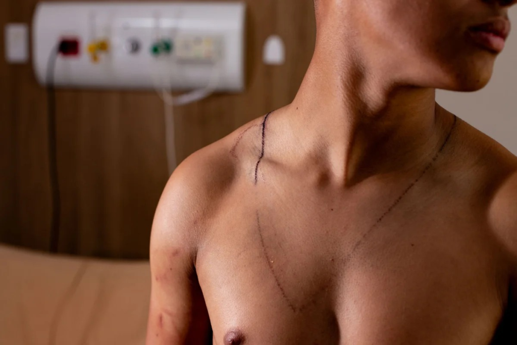 Raio em ato de Nikolas: jovem que teve as costas rasgadas recebe alta - VEJA AS FOTOS