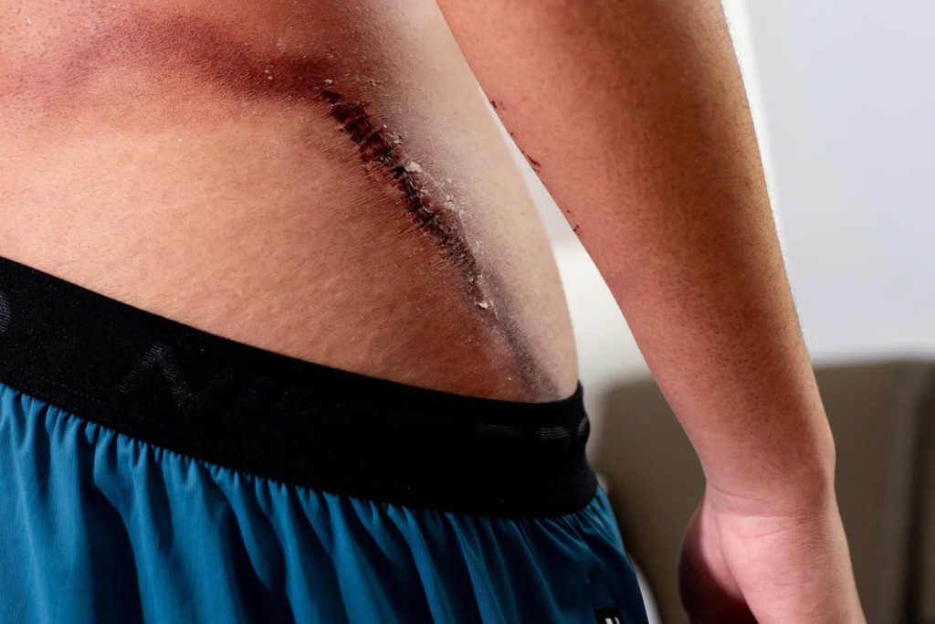 Raio em ato de Nikolas: jovem que teve as costas rasgadas recebe alta - VEJA AS FOTOS