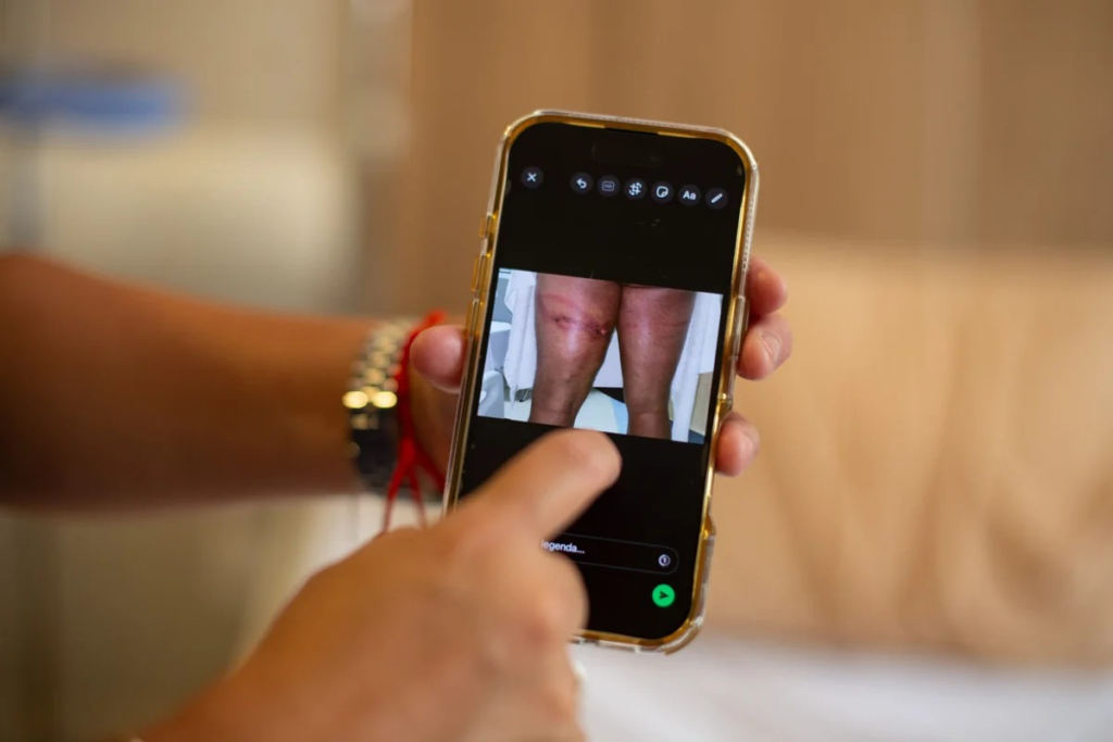 Raio em ato de Nikolas: jovem que teve as costas rasgadas recebe alta - VEJA AS FOTOS