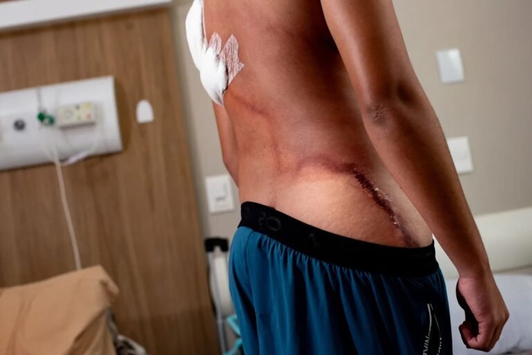 Raio em ato de Nikolas: jovem que teve as costas rasgadas recebe alta – VEJA AS FOTOS