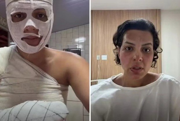 Nutricionista tem 33% do corpo queimado após explosão de saco de lixo