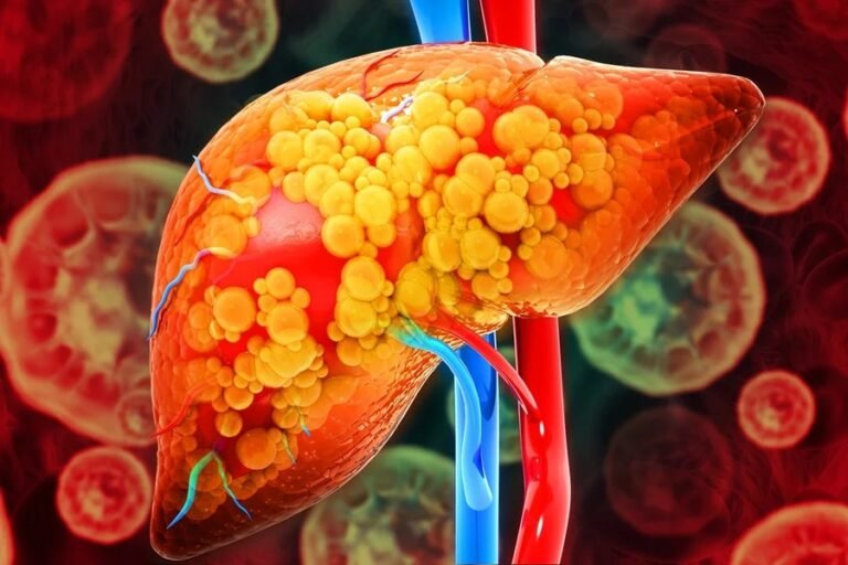 Hepatologista aponta sinais de alerta do avanço da gordura no fígado
