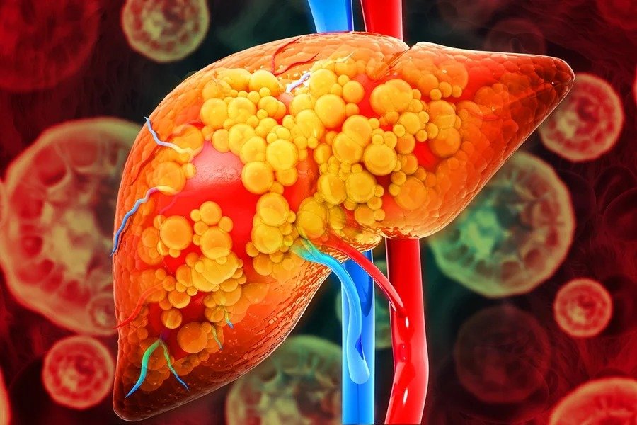Hepatologista aponta sinais de alerta do avanço da gordura no fígado