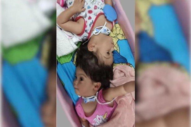Gêmeas siamesas unidas pela cabeça morrem em cirurgia de separação